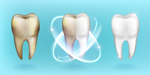 Como evitar placa bacteriana nos dentes: saiba Como evitar placa bacteriana nos dentes: saiba