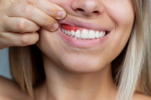 Periodontite: Causas, Sintomas e Tratamentos Disponíveis