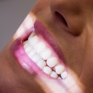 Clareamento Dental de Última Geração