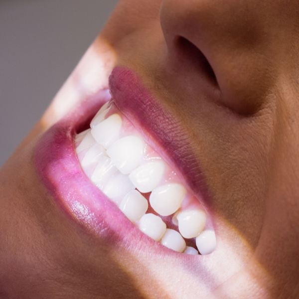 Clareamento Dental de Última Geração