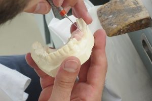 Como funciona a restauração dentária