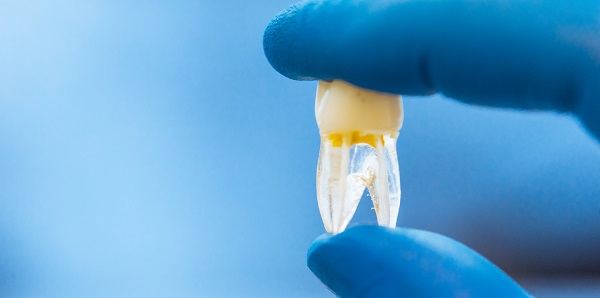 O que é a descalcificação dos dentes
