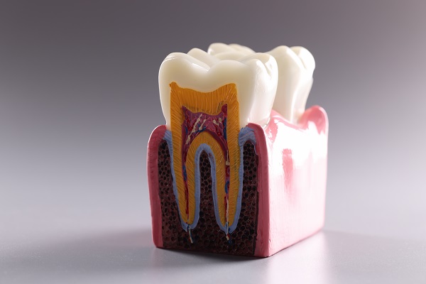 O que é periodontite e como prevenir esta doença