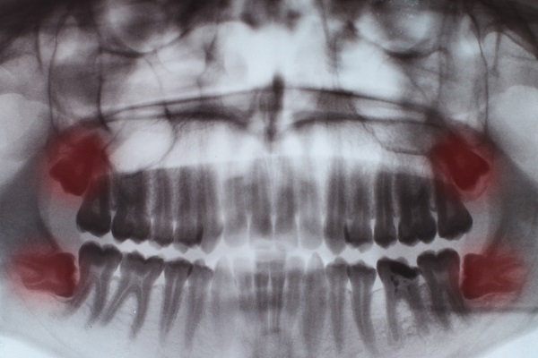 Como saber a hora de tirar os dentes do siso?