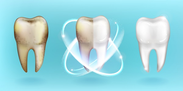 Como evitar placa bacteriana nos dentes: saiba