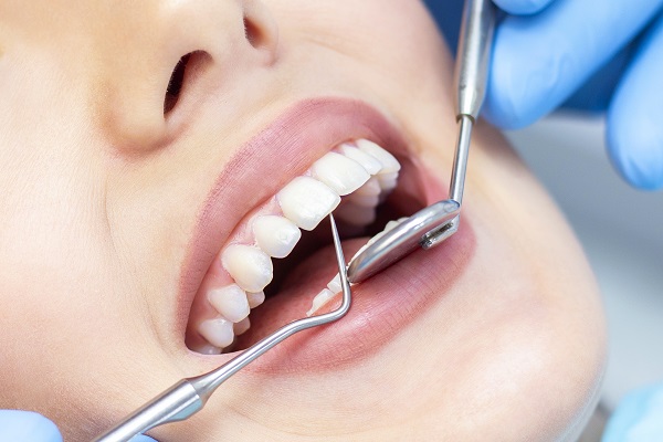 Como evitar placa bacteriana nos dentes
