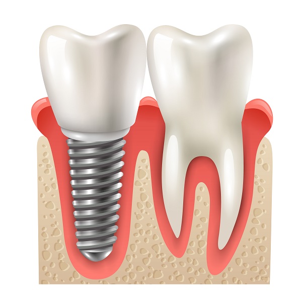 Como cuidar do implante dentário: descubra