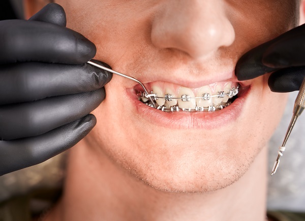 Motivos para não parar o tratamento ortodôntico: veja! - Dental Arte